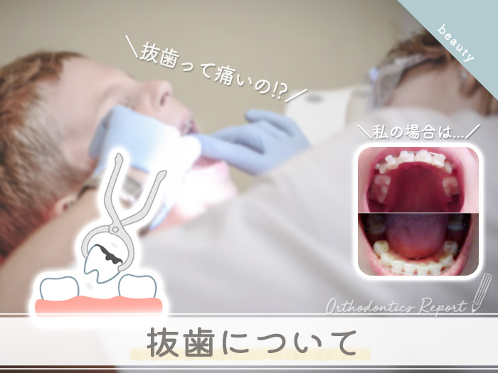 歯列矯正体験談 抜歯について