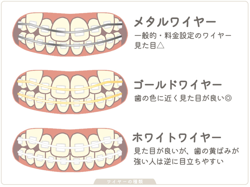 歯列矯正 ワイヤーの種類