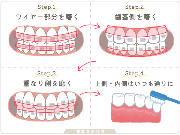 歯列矯正中の歯磨きの仕方2ワイヤー面