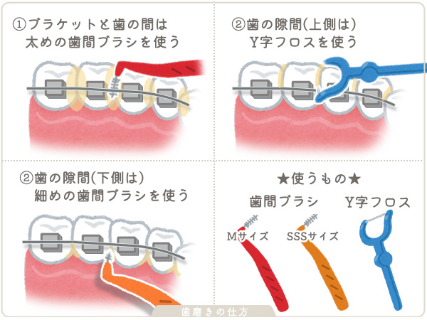 歯列矯正中の歯磨きの仕方3歯間