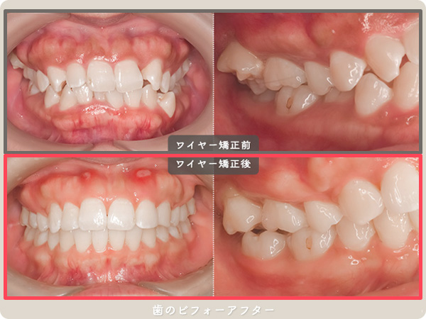 顔面ビフォーアフター 歯全体の変化1